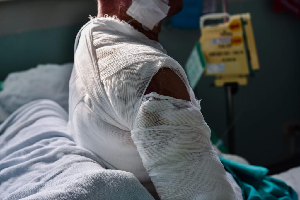 A patient sitting up in a hospital bed with extensive white gauze medical bandages covering their shoulder, chest, and arm, illustrating severe injuries for Broward County Burn Injury Lawyers.