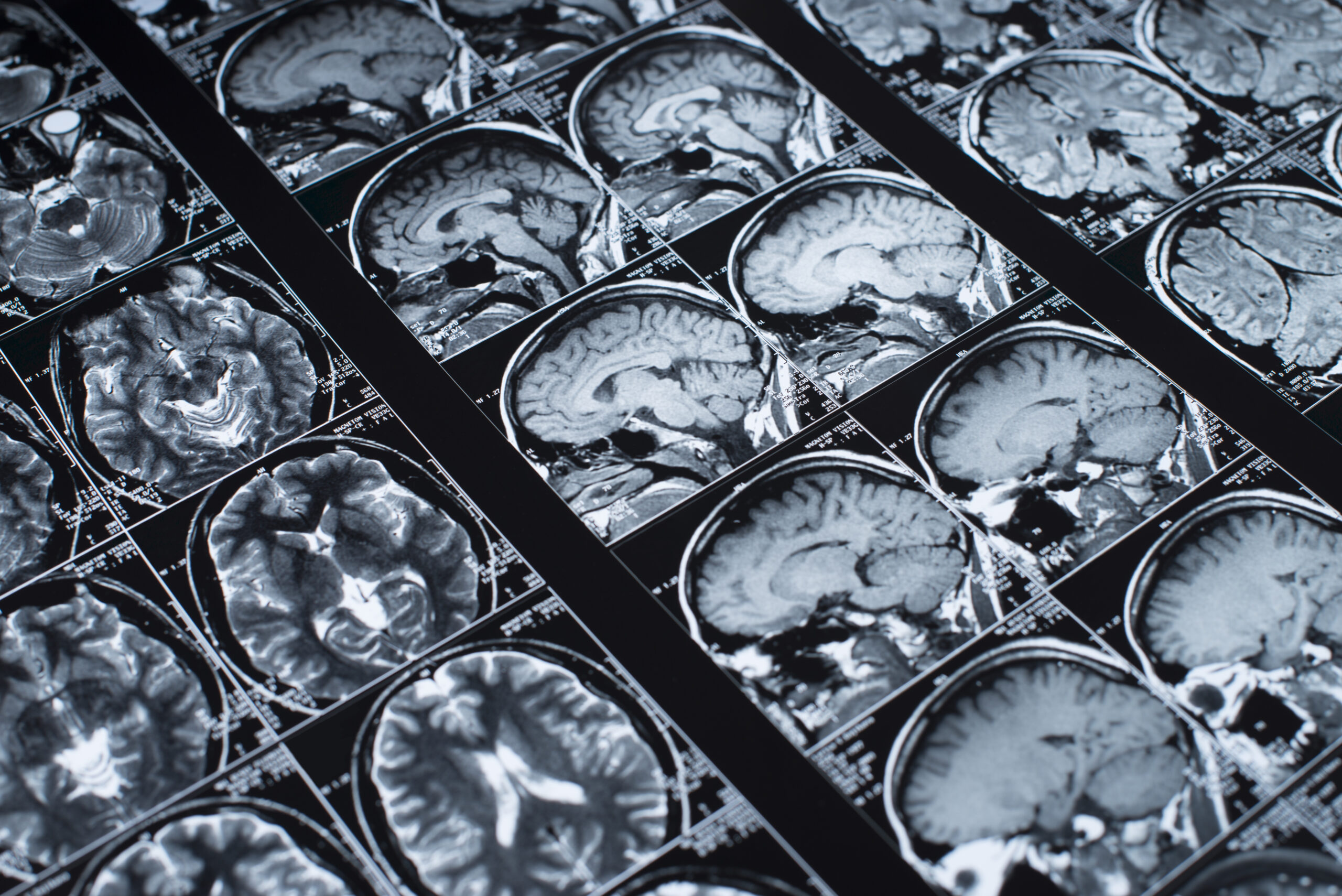 Brain scan images showing different views of the head and brain